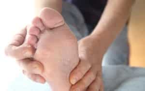 A man checks the dry, peeling skin of his athletes foot fungus between his toes.