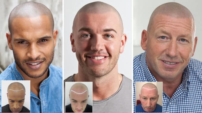 Scalp micro pigmentation before and after pictures