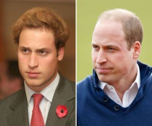 prince William before and after hair loss