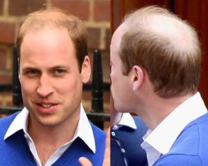Prince William with a receding hairline
